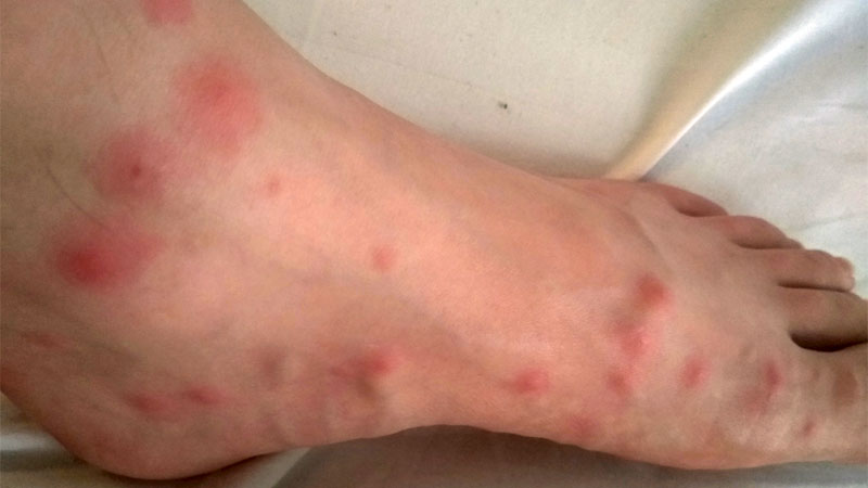 Midge Bites Symptoms What They Look Like And How To Treat